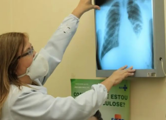 SUS vai oferecer três novos medicamentos para o tratamento de câncer de pulmão